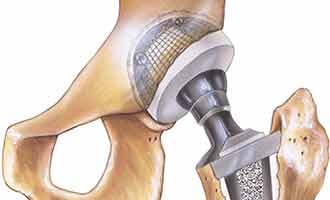 An illustration of a metal on metal hip implant. 