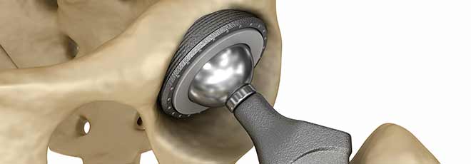 An illustration of a hip replacement. 