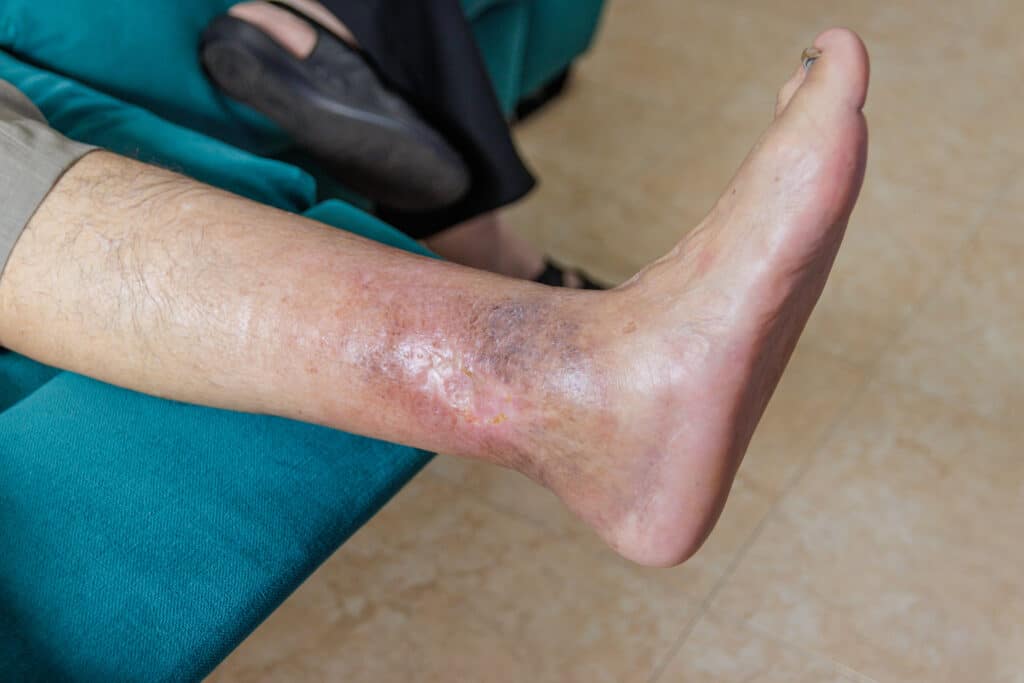 Image of an infection on someones ankle. 